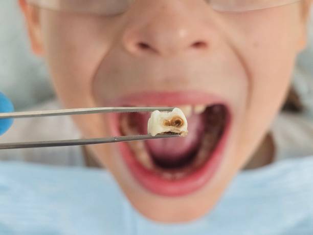 Best Emergency Broken Tooth Repair in Eden Isle, LA