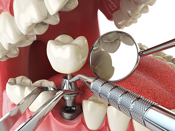 Best Emergency Root Canal Treatment in Eden Isle, LA